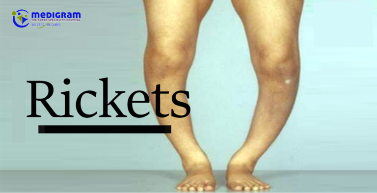 RICKETS