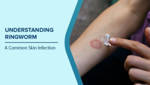 Ringworm
