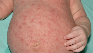 SCABIES