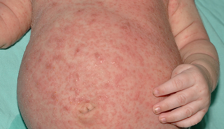 SCABIES