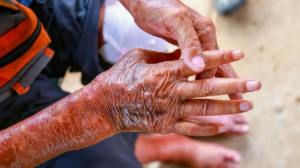 SCLERODERMA