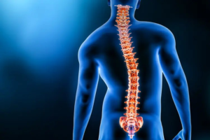 Scoliosis