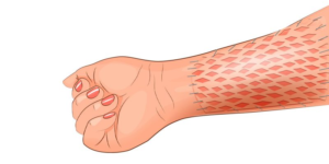 SKIN GRAFTING