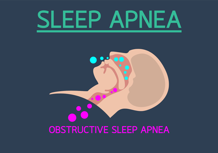 SLEEP APNEA