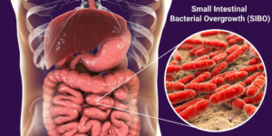 SMALL INTESTINAL BACTERIAL OVERGROWTH