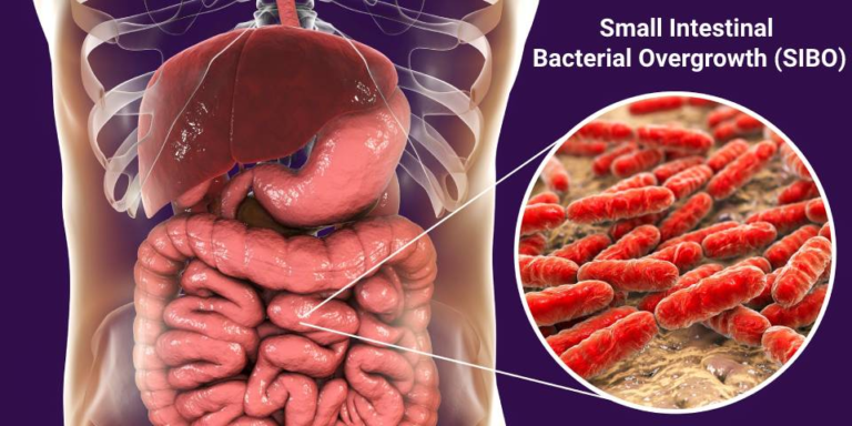 SMALL INTESTINAL BACTERIAL OVERGROWTH
