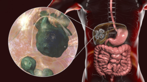 TAPEWORM INFECTION