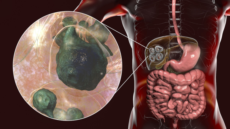 TAPEWORM INFECTION