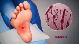 TETANUS
