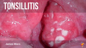TONSILLITIS