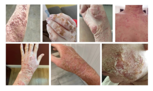 TOPICAL STEROID WITHDRAWAL (TSW) AND ECZEMA