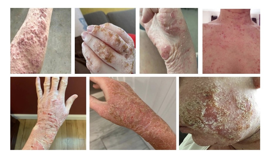 TOPICAL STEROID WITHDRAWAL (TSW) AND ECZEMA