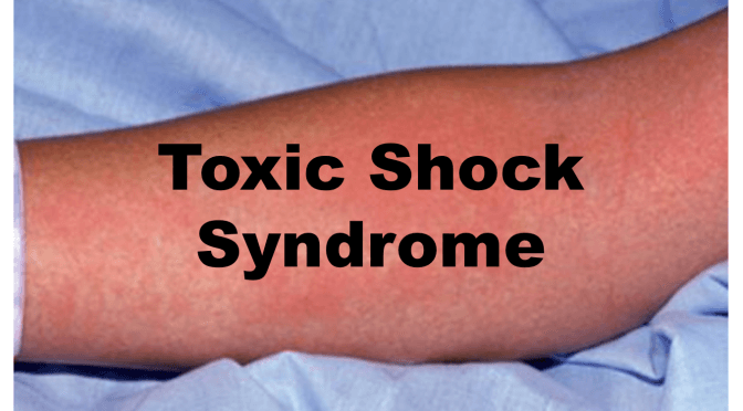 TOXIC SHOCK SYNDROME