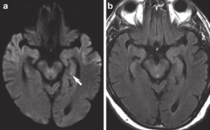 Transient global amnesia