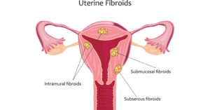 UTERINE FIBROID