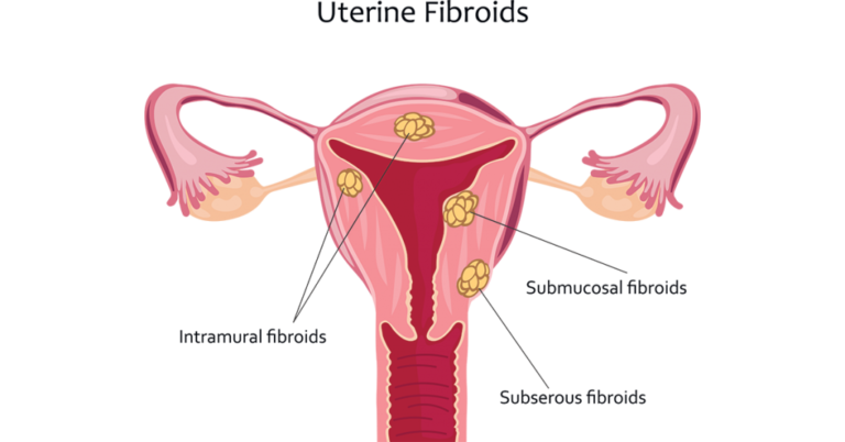 UTERINE FIBROID