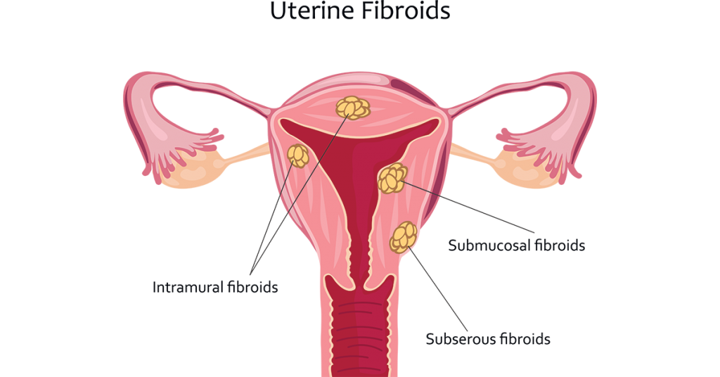 UTERINE FIBROID