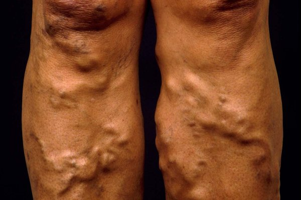 VARICOSE VEINS