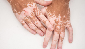 VITILIGO
