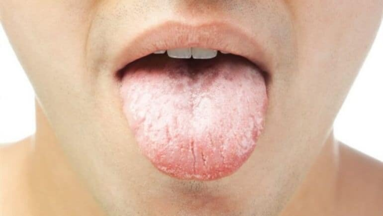 XEROSTOMIA (DRY MOUTH)