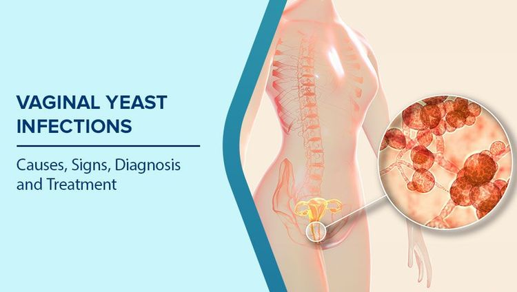 YEAST INFECTION