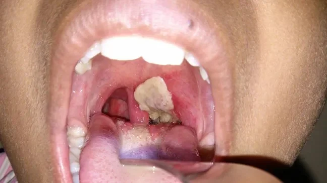 DIPHTHERIA