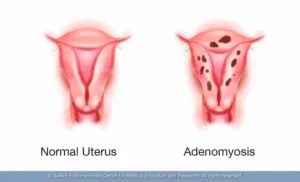 ADENOMYOSIS