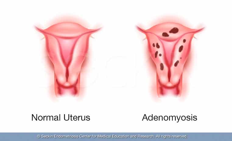 ADENOMYOSIS