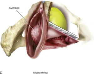 ANTERIOR VAGINAL PROLAPSE (CYSTOCELE)