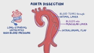 AORTIC DISSECTION