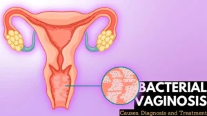 BACTERIAL VAGINOSIS