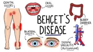 BEHCET'S DISEASE