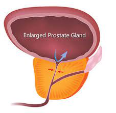 BENIGN PROSTATIC HYPERPLASIA (BPH)