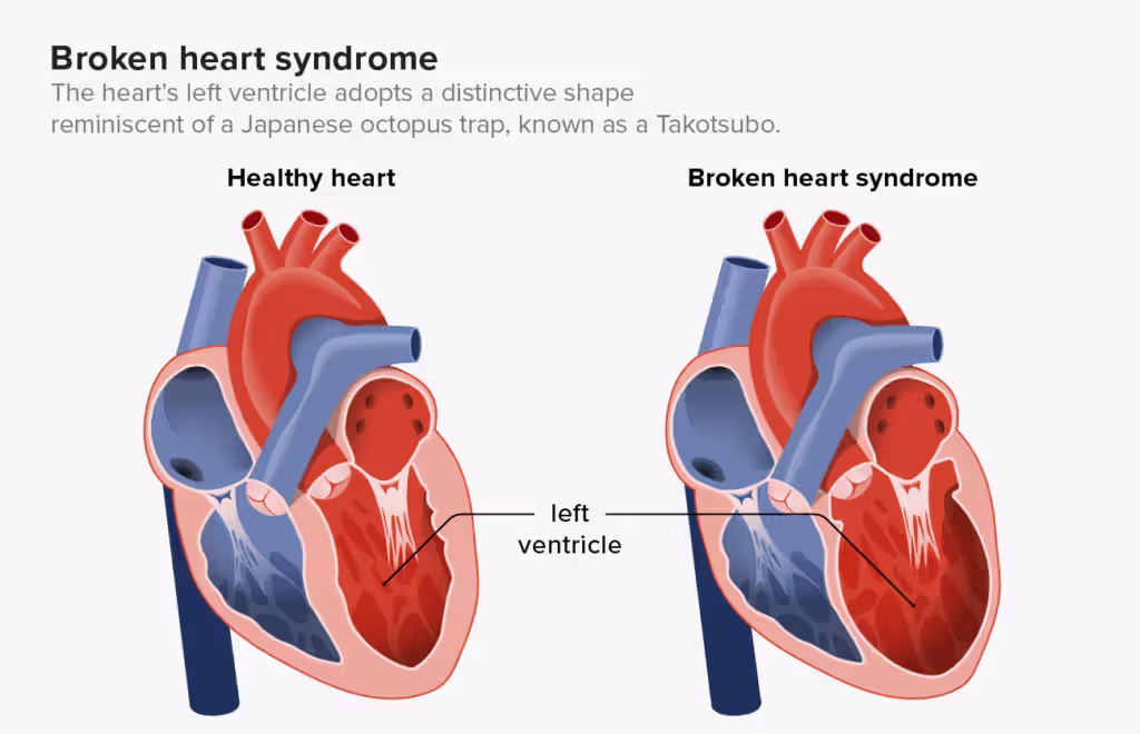 BROKEN HEART SYNDROME