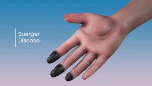 BUERGER'S DISEASE