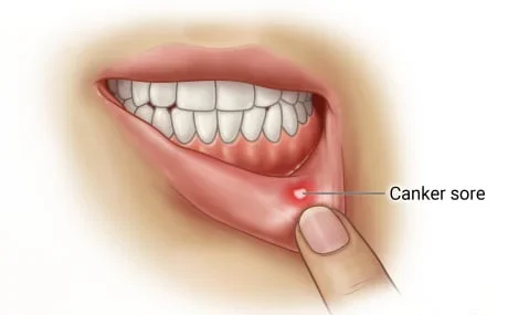 CANKER SORES