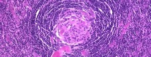 CASTLEMAN DISEASE
