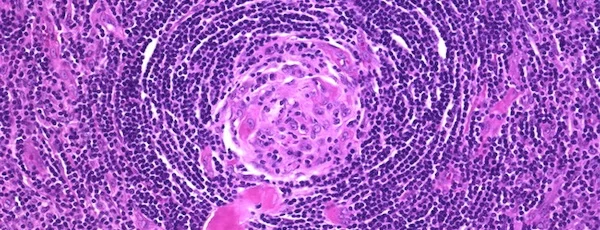 CASTLEMAN DISEASE