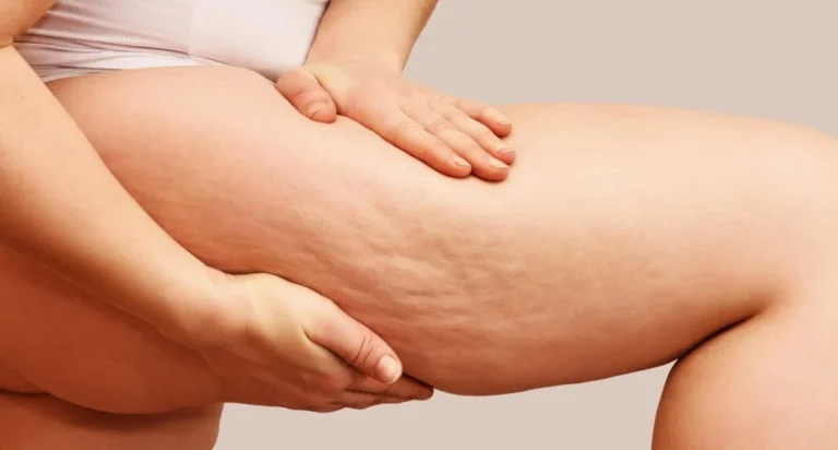 CELLULITE