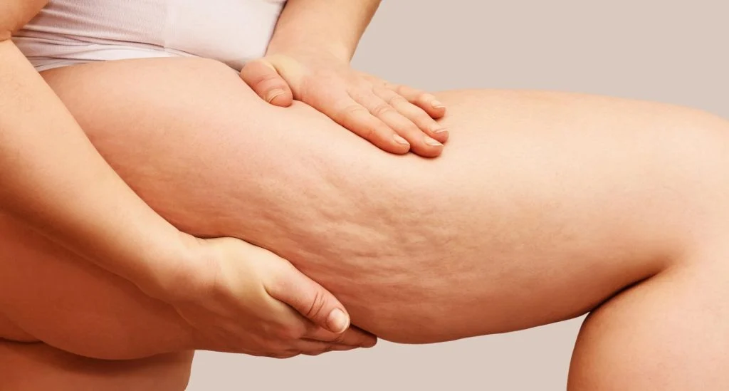 CELLULITE