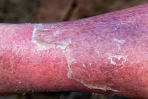 CELLULITIS