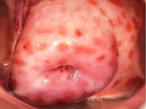 CERVICITIS