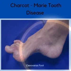 CHARCOT-MARIE-TOOTH DISEASE