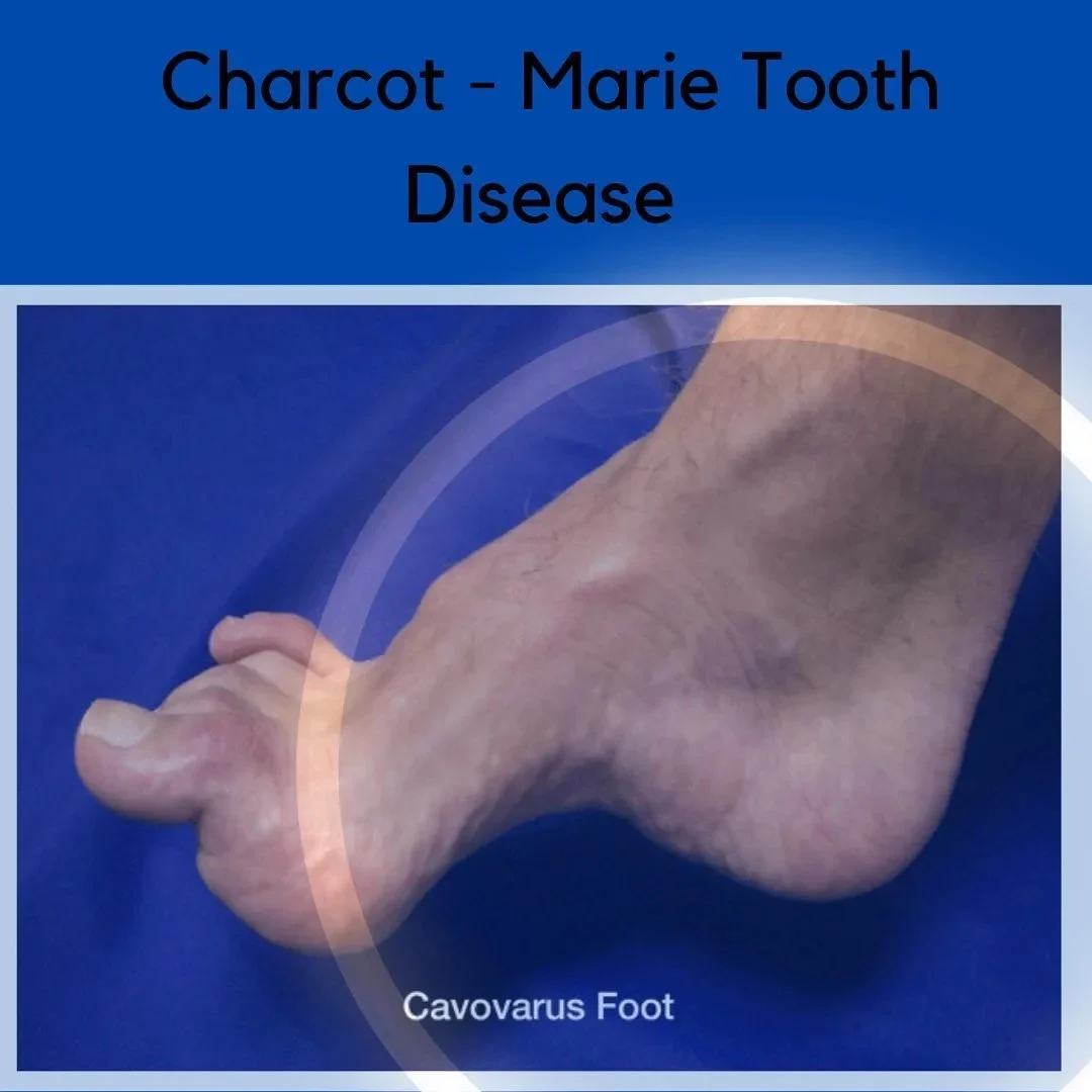 CHARCOT-MARIE-TOOTH DISEASE