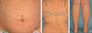 CHOLESTASIS OF PREGNANCY
