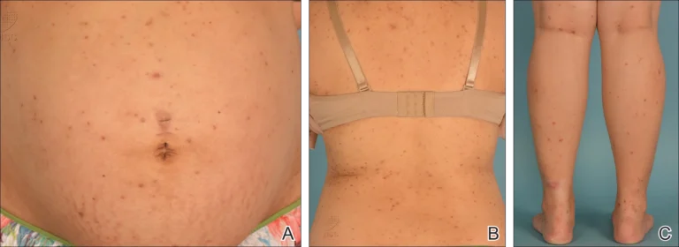 CHOLESTASIS OF PREGNANCY