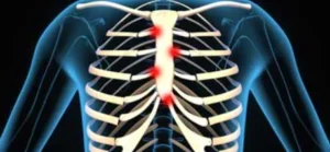 COSTOCHONDRITIS