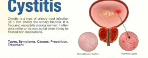 CYSTITIS