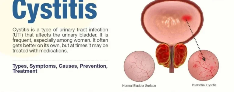 CYSTITIS