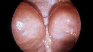 DOUBLE UTERUS